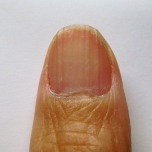 いいかね、若い人たちへ…爪に縦線がめっちゃ入るということは（笑）